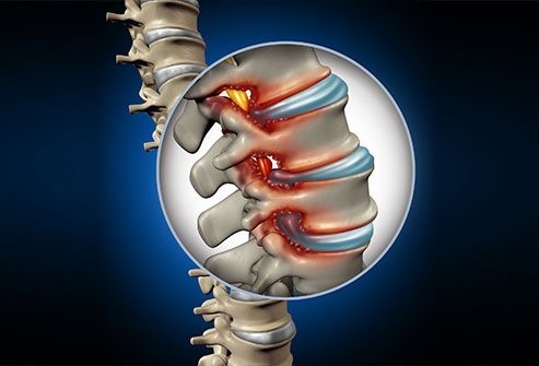 Lumbar Disc Disease